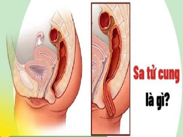 Sa tử cung là gì?